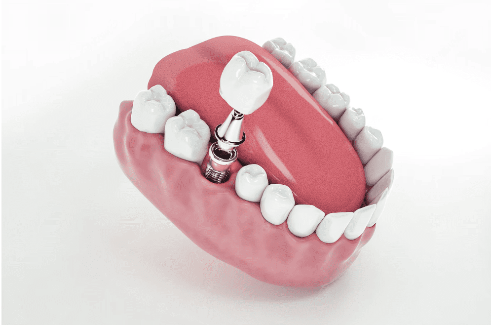 Image illustrating all-on-4 dental implants by City Dental Clinic, a dental clinic in Albania.