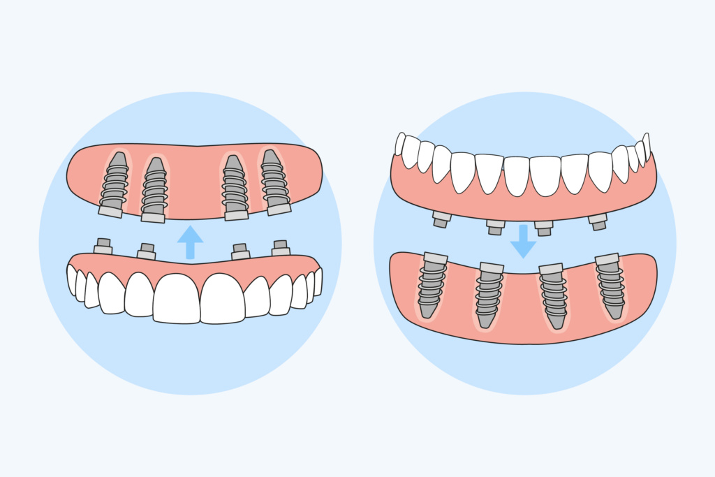 Image illustrating all-on-4 dental implants by City Dental Clinic, a dental clinic in Albania.