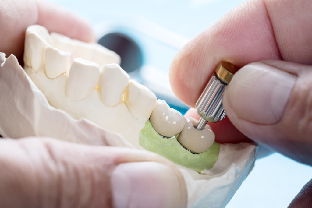 Image illustrating all-on-4 dental implants treatments by CDC, a dental clinic in Albania.