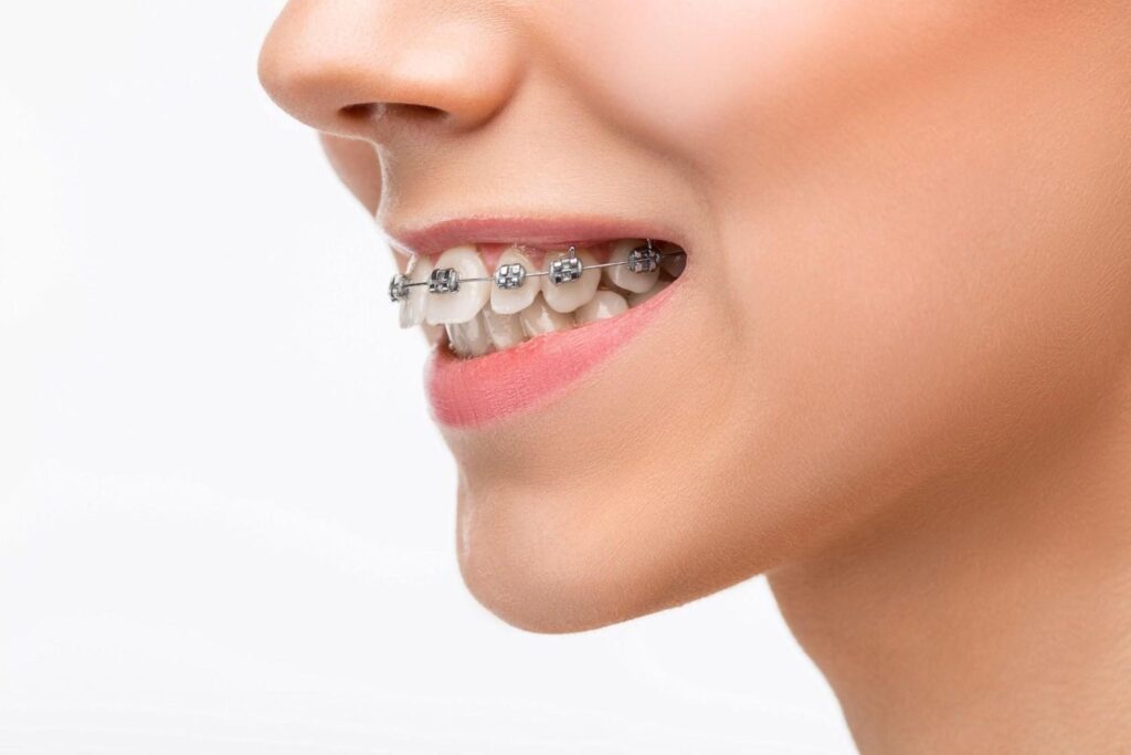 Affordable braces in Albania
