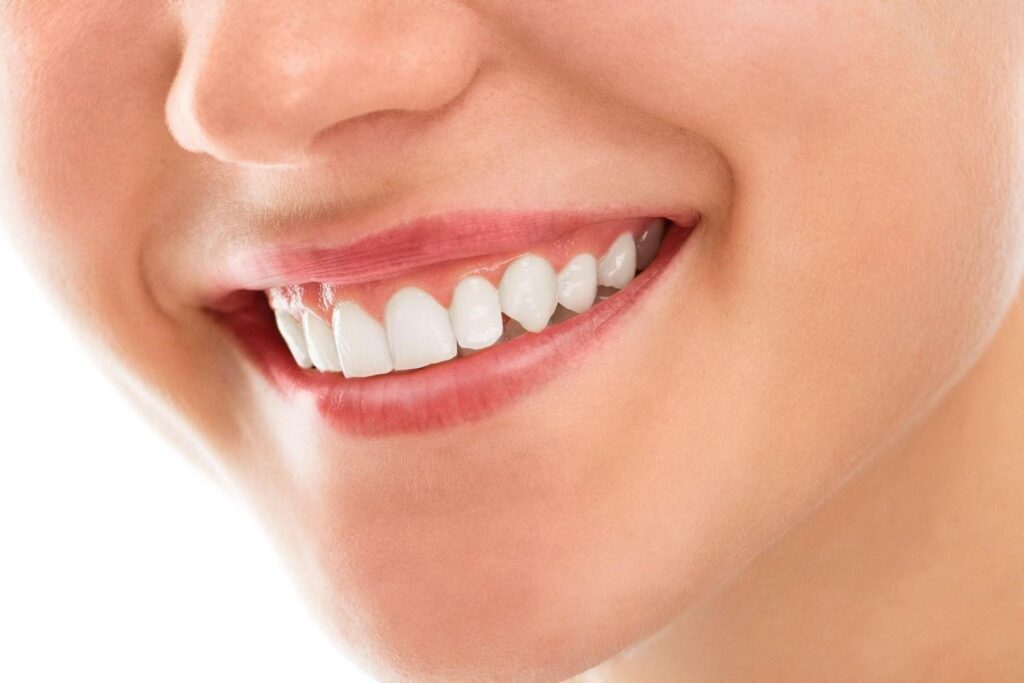 Braces in Albania, amazing teeth straightening results.