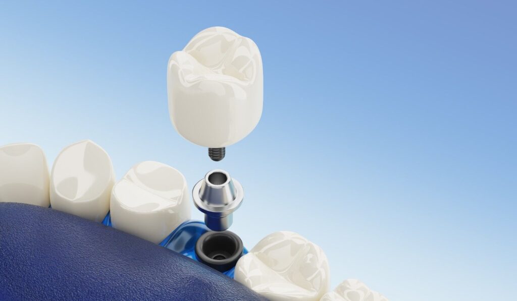 Different types of dental implant abutments