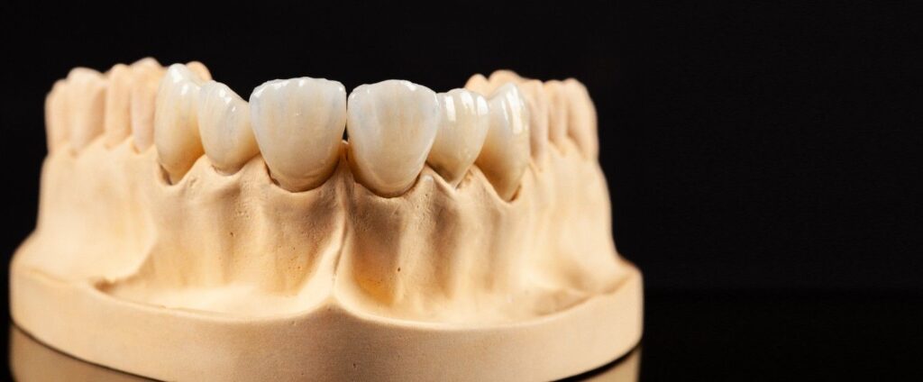 The best dental crowns in Albania, durable dental implants