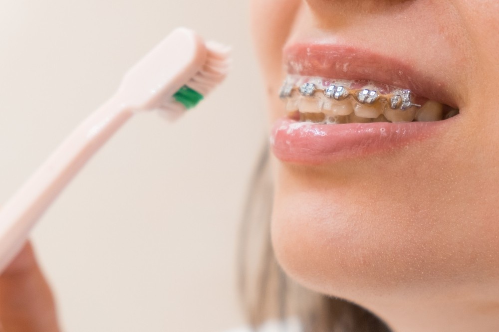Oral hygiene tips for people with braces
