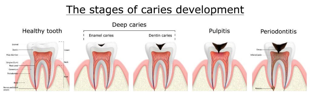 The formation of tooth cavities