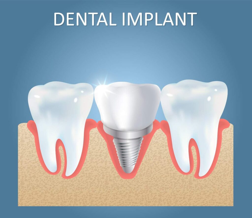 Affordable dental implants in Albania