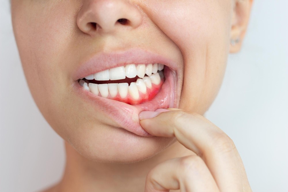 Gum disease as a dental emergency