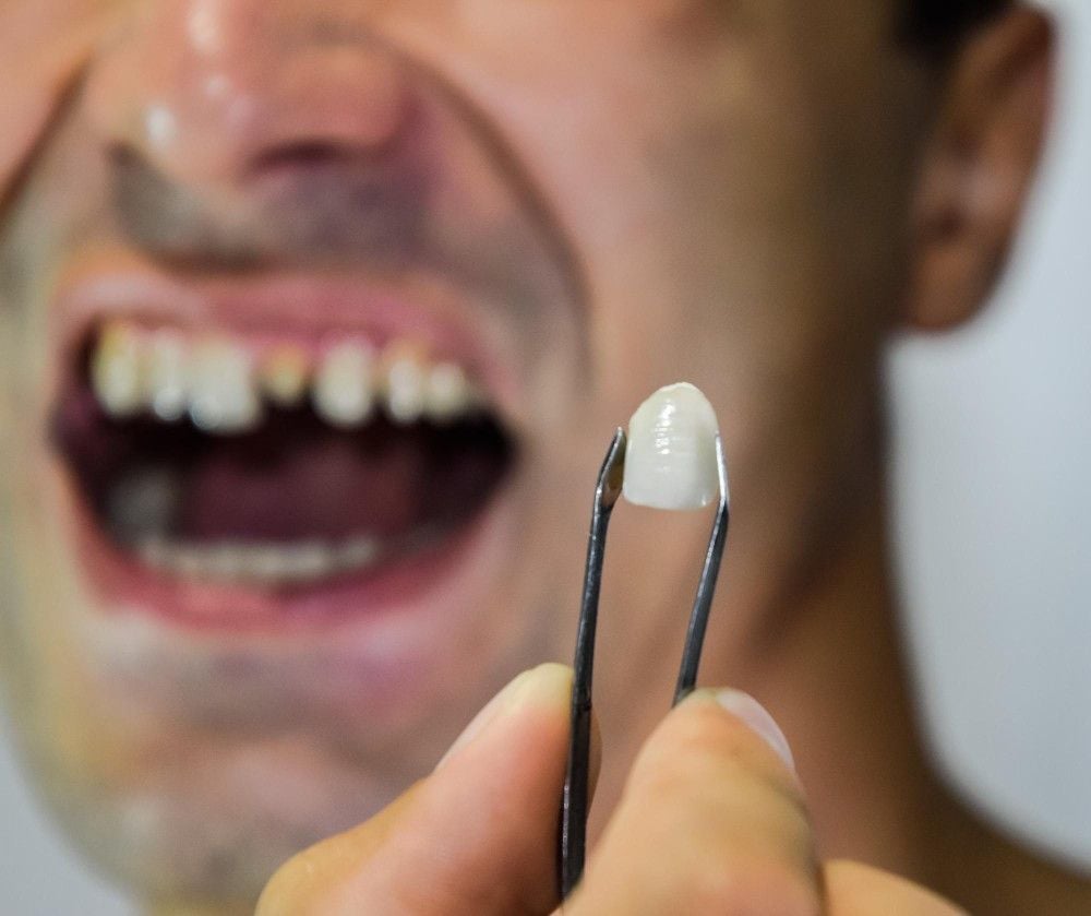 Dental bridge falling out