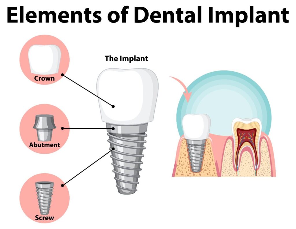 Endosteal Implant surgery in Albania
