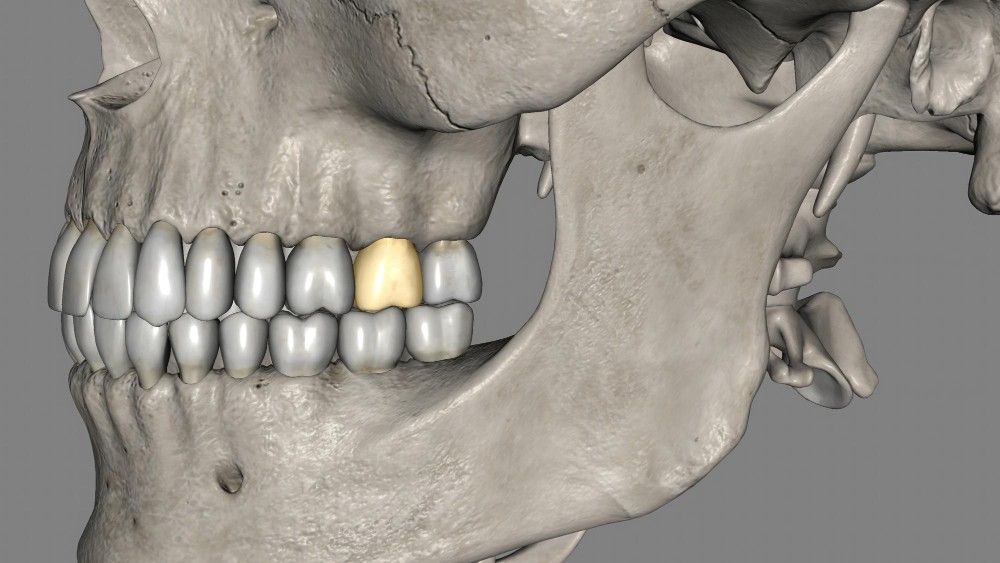 types of dental crowns in Albania