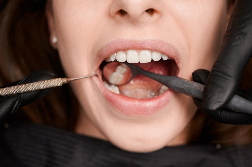Dental filling procedure in Albania