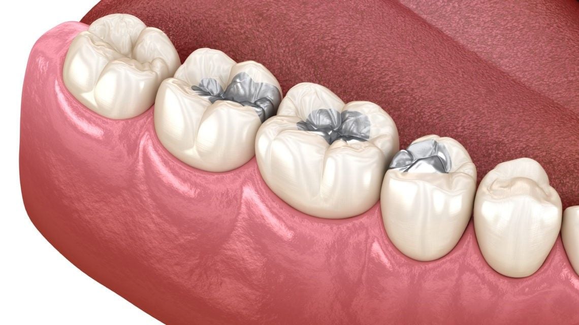 Amalgam fillings