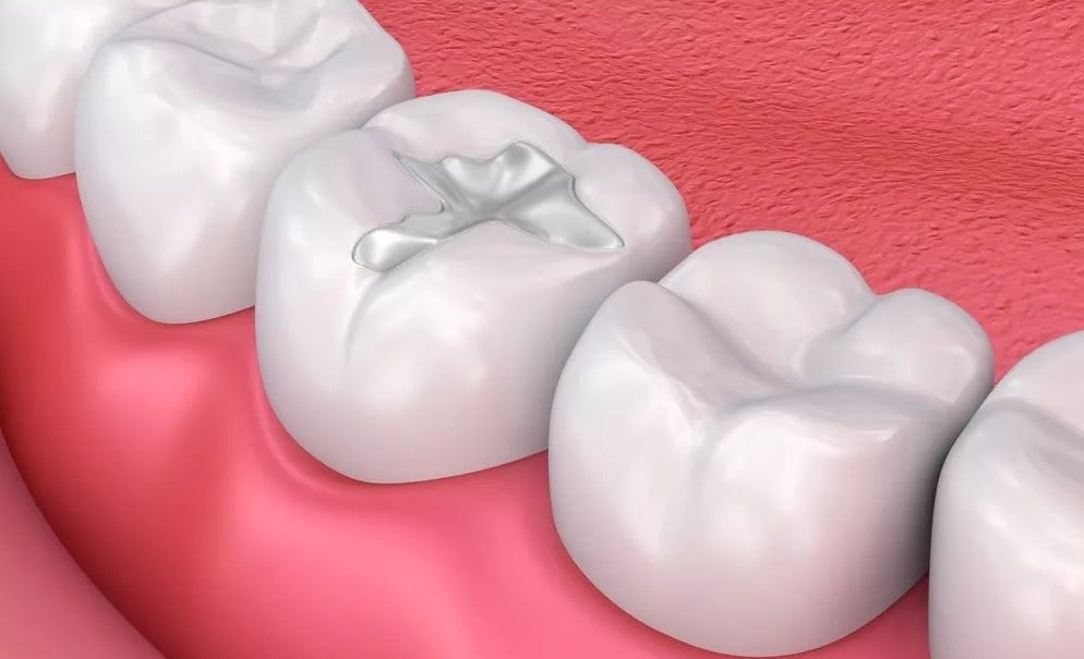 Composite fillings or white dental fillings