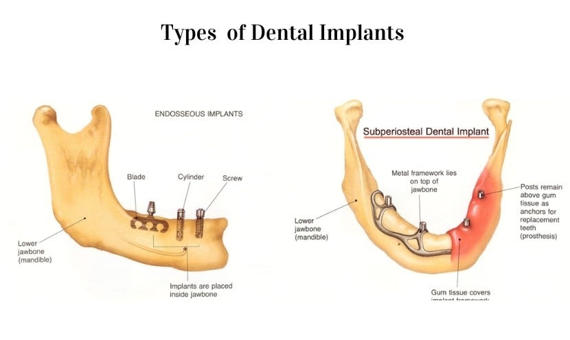 Endosteal Implant vs subperiosteal implants