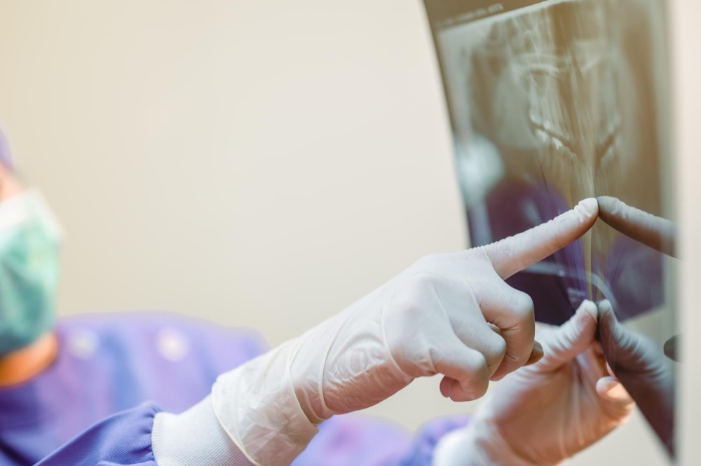 all on 4 and all on 6 dental implants in Albania, dentist evaluating x-ray