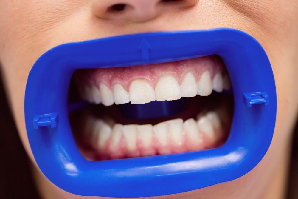 gingivoplasty in Albania, affordable gum surgery in Tirana