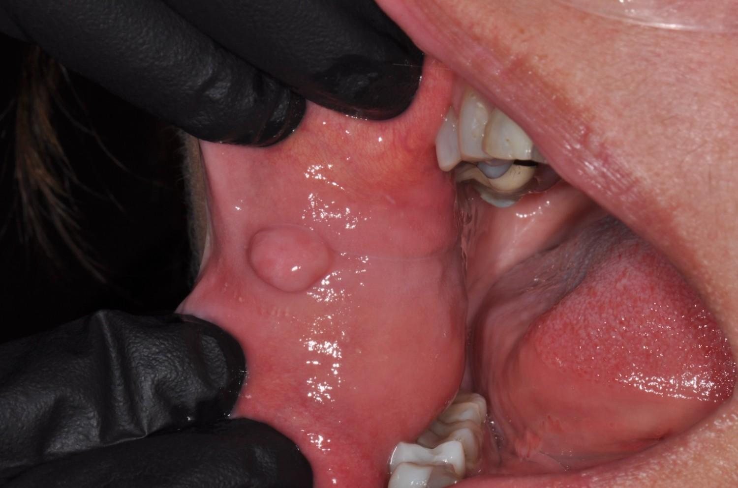 Oral fibroma, treatment at a dental clinic in Albania