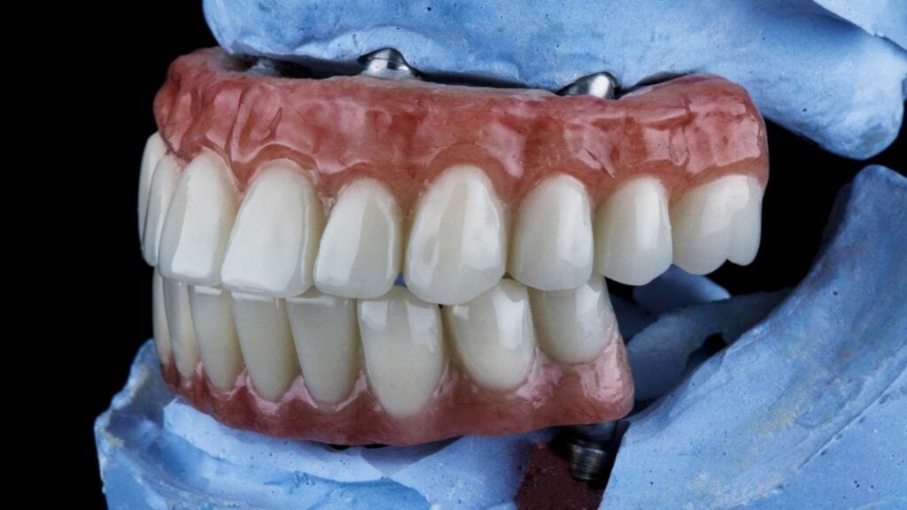 the impact of wearing a dental prosthesis on your gums