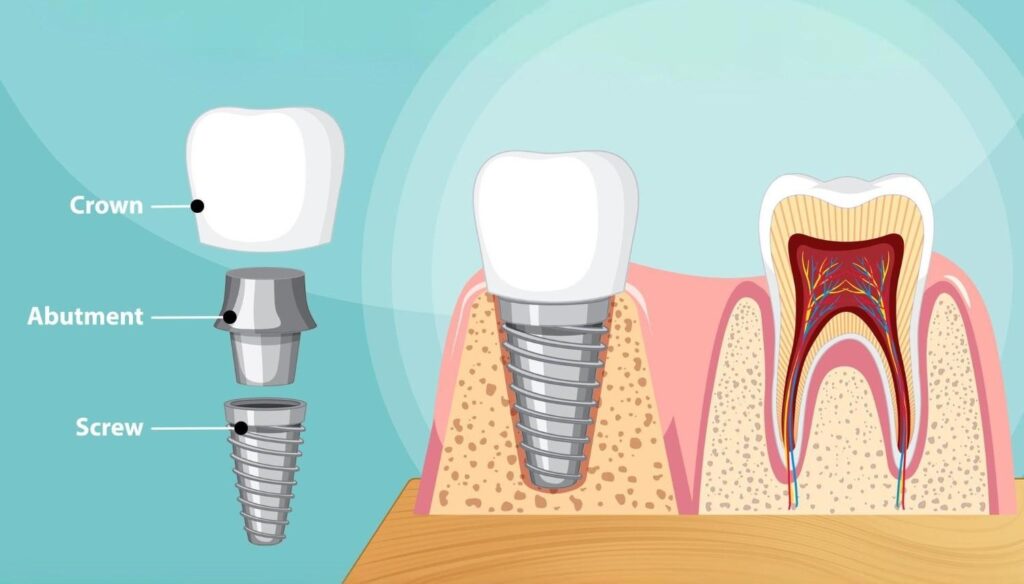 the parts of a dental implant, dental crown, abutment and titan screw