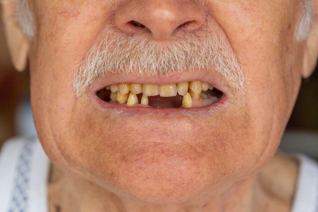 full teeth replacement with dental implants in Albania