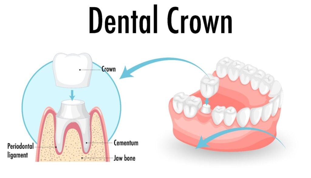 dental crown structure