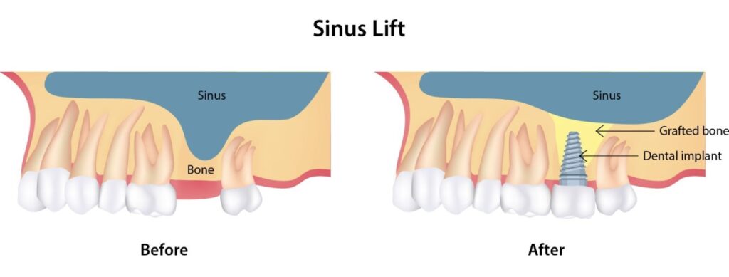 sinus lift in Albania