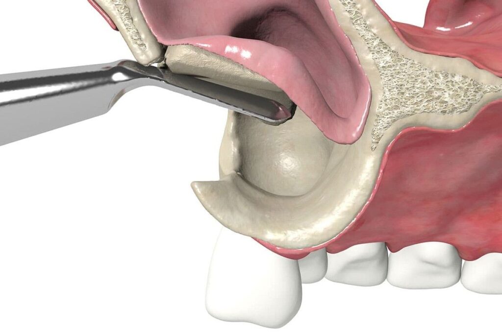 sinus lift before dental implants in Albania