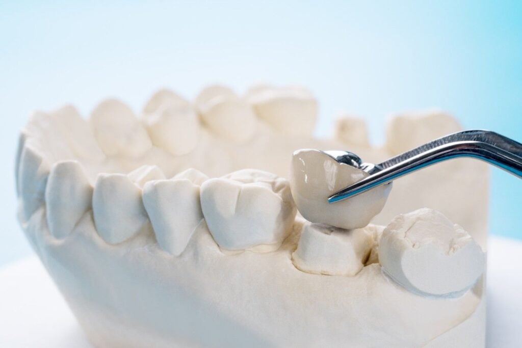 dental crown materials