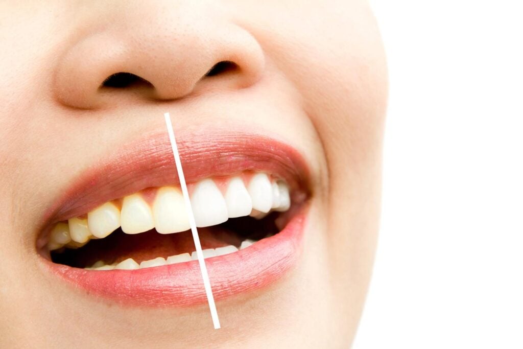 professional teeth whitening in Albania