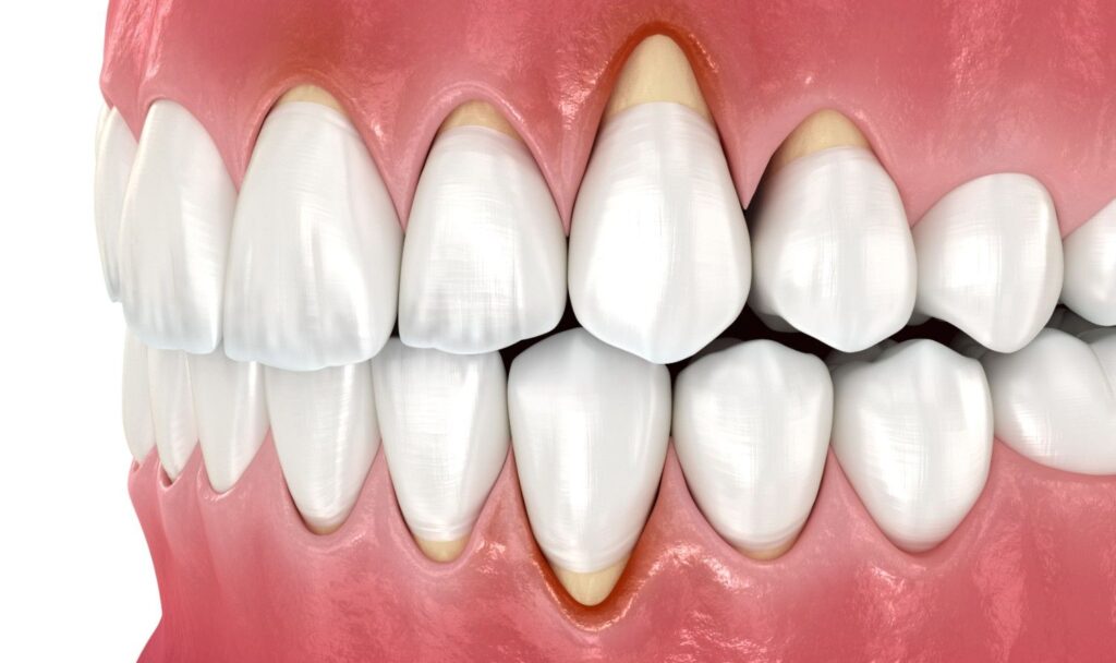 receding gums treatments in Albania