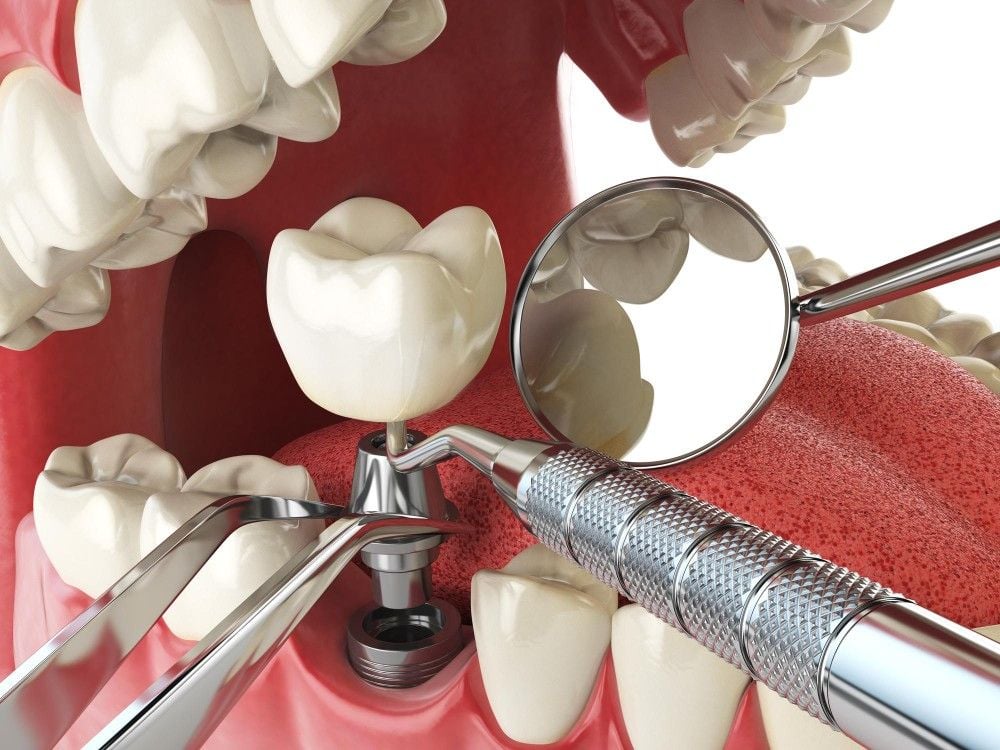 immediate loading implants in Albania