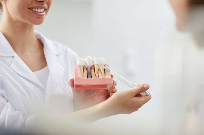 Immagine che illustra gli impianti dentali con per pazienti con poco osso.