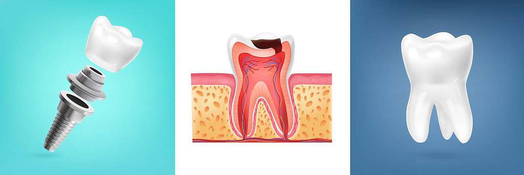i migliori impianti dentali in Albania