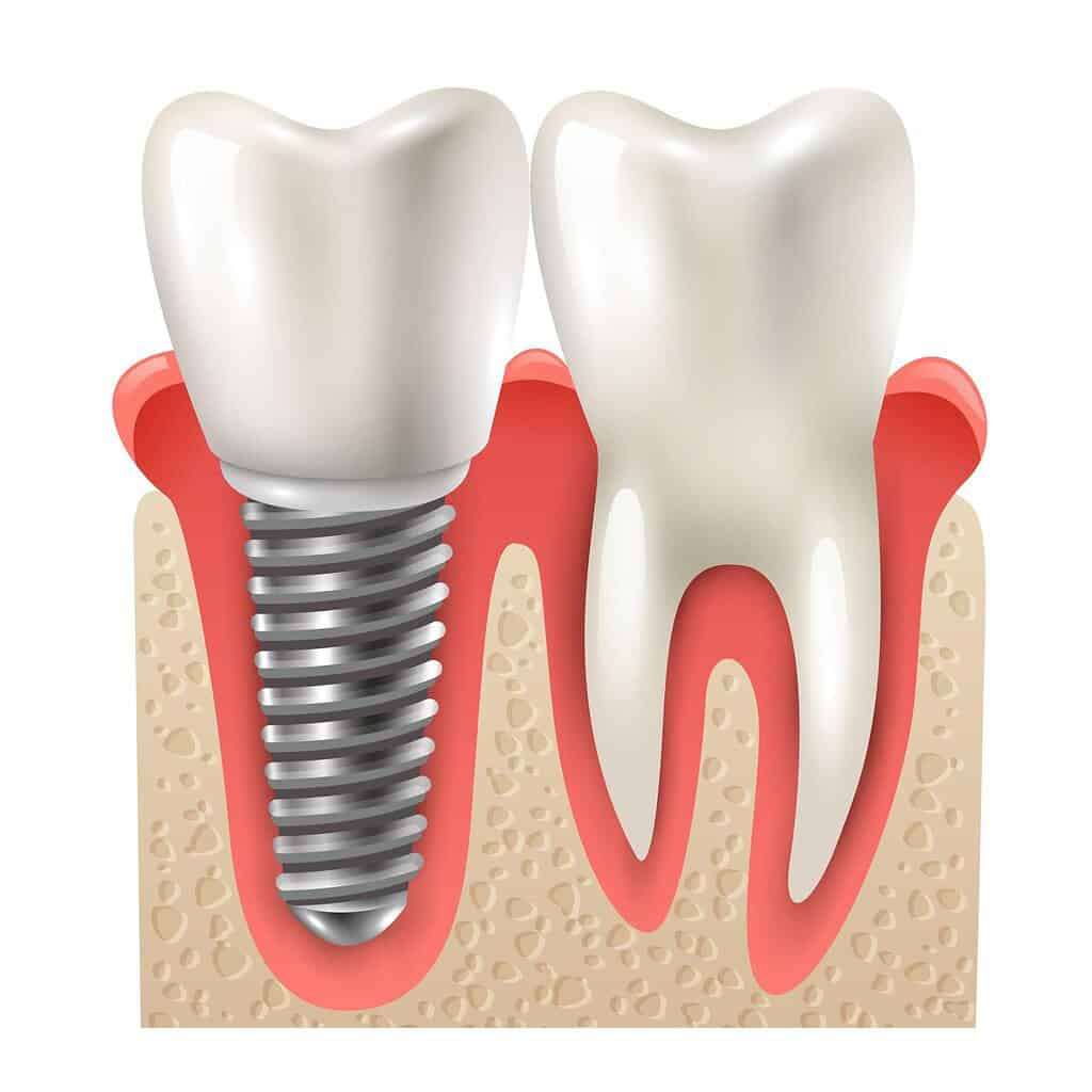 la migliore clinica dentale per gli imianti dentali in Albania
