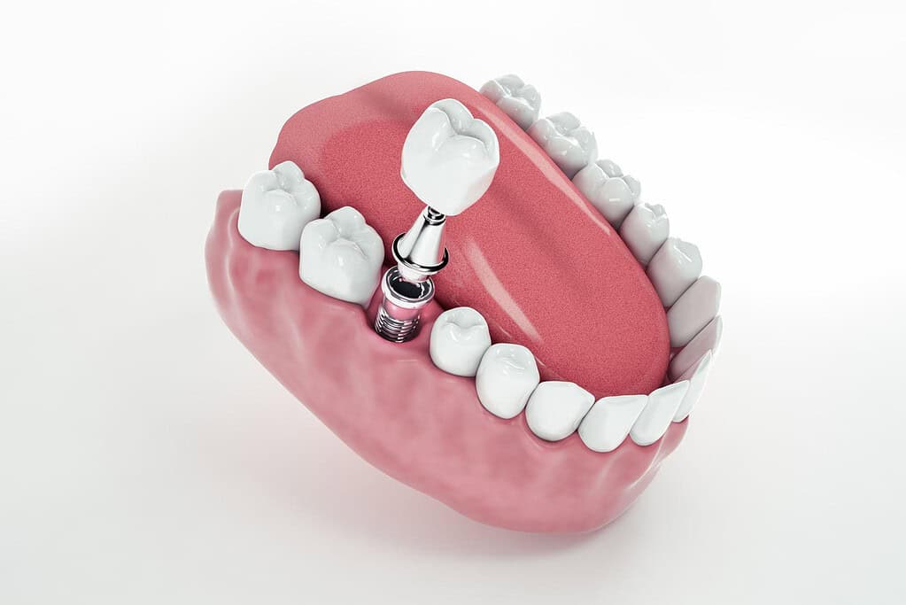 i migliori impianti dentali a prezzi accessibili in Albania