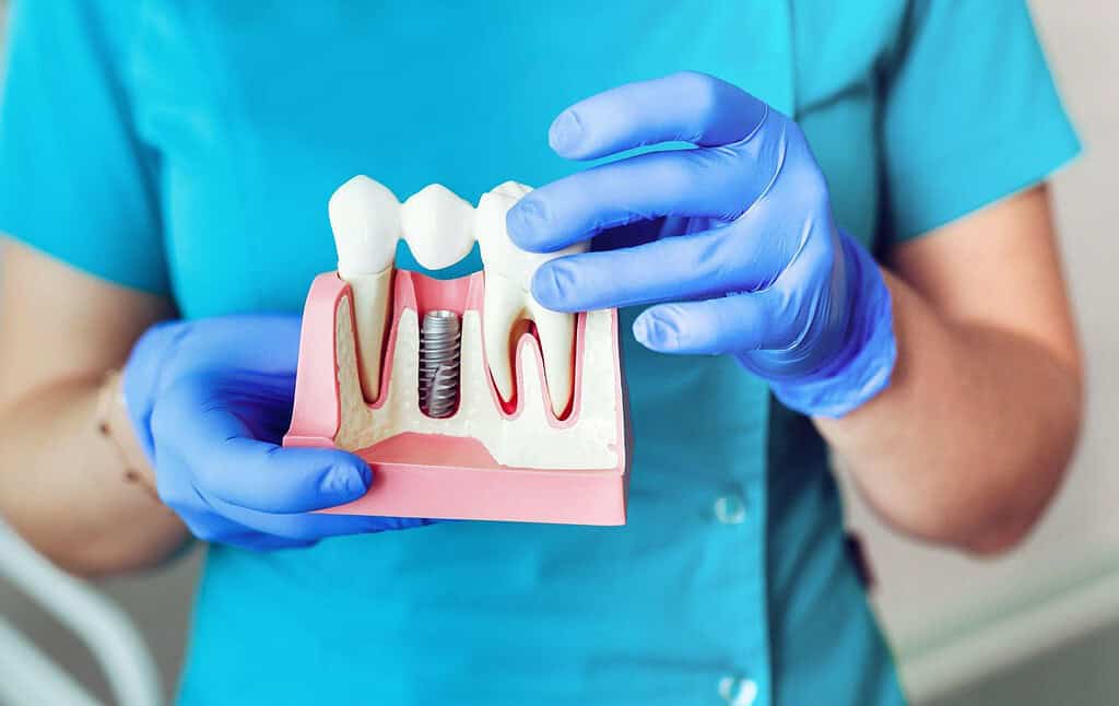 Immagine che illustra gli impianti dentali convenienti in Albania