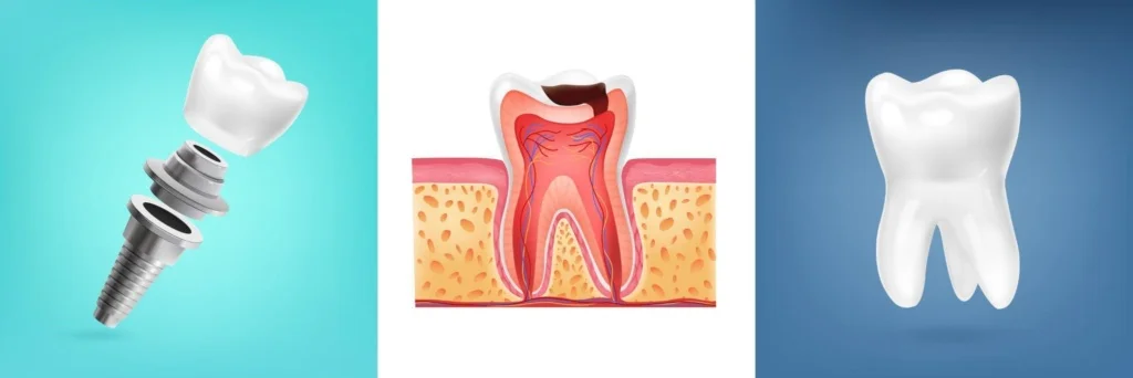 Immagine che illustra gli impianti dentali in Albania