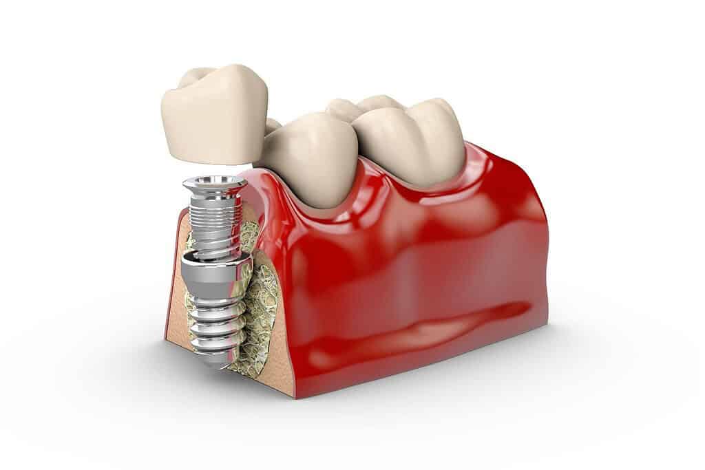 Immagine che illustra impianti dentali di alta qualità in Albania