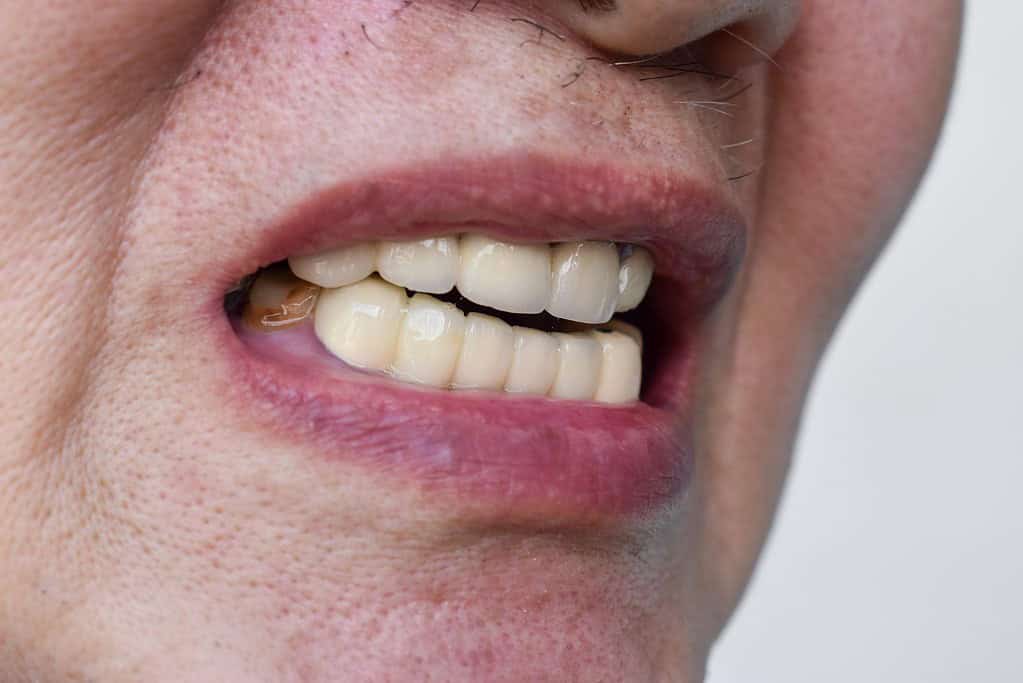 Immagine che illustra problemi ai denti dovuti a disturbi alimentari