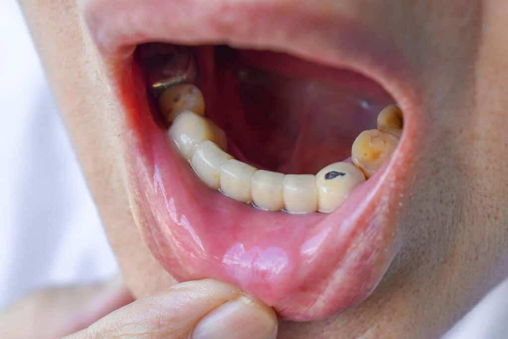 Immagine che illustra problemi ai denti che richiedono l'assistenza di un dentista in Albania