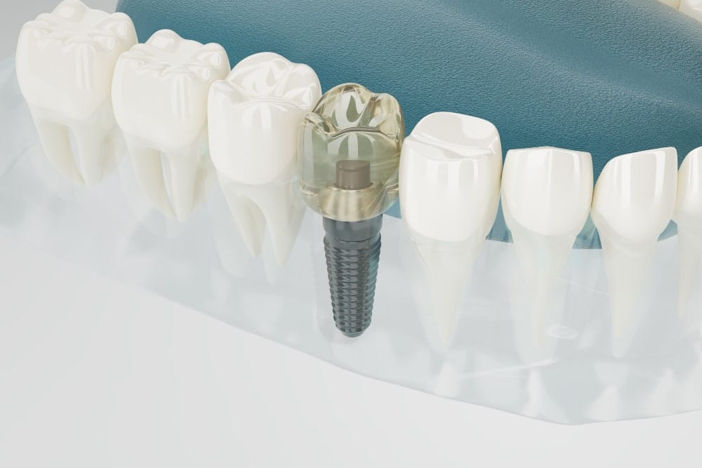 Immagine che illustra il corretto adattamento degli impianti dentali in Albania