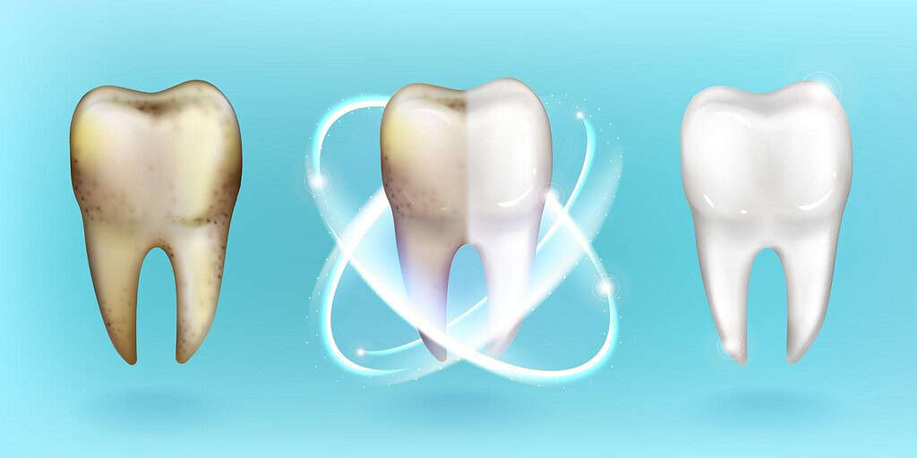 Immagine che illustra la carie che può essere curata da un dentista in Albania