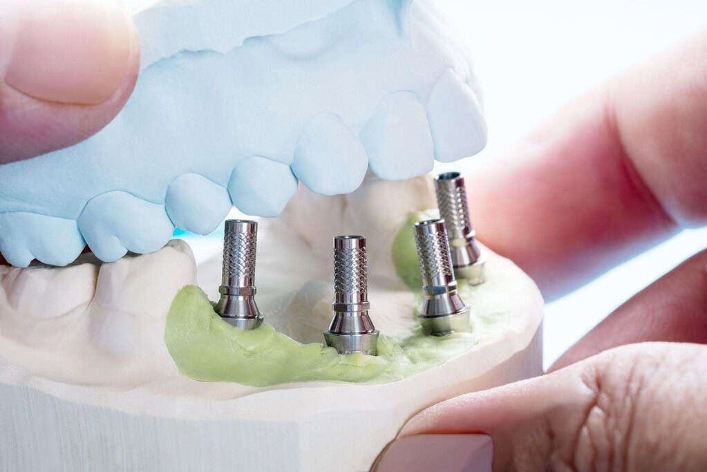 Immagine che illustra un dentista in Albania che mostra un mockup per impianti dentali.