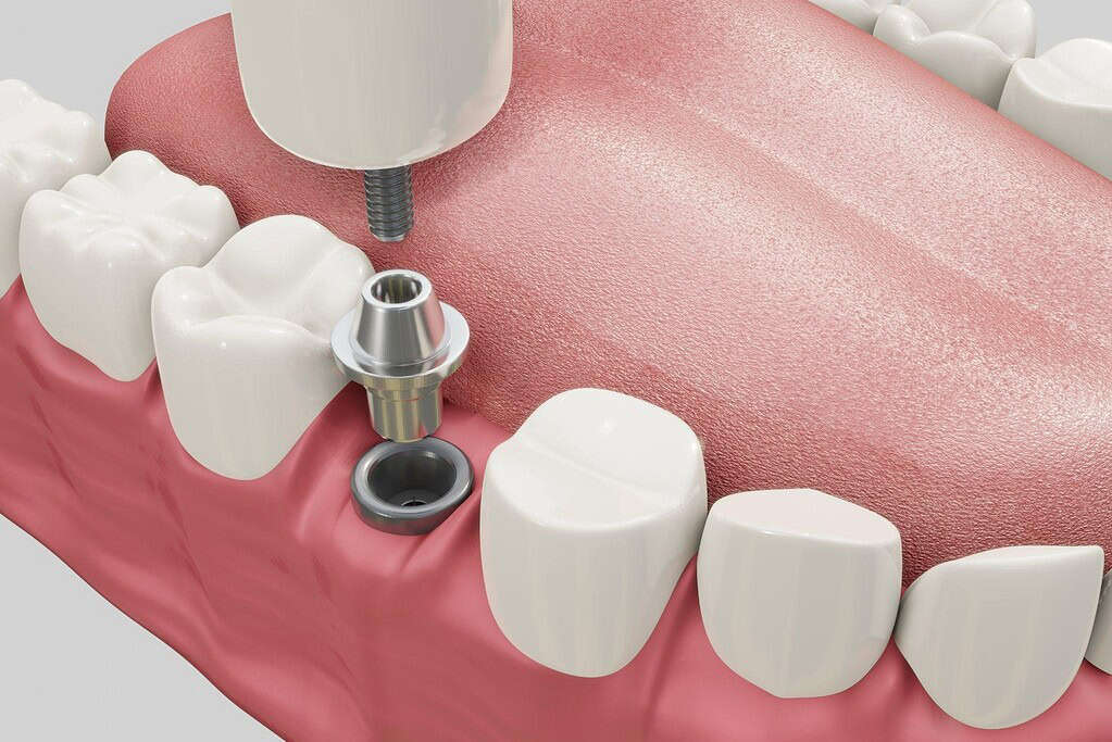 Immagine che illustra un mockup per impianti dentali in Albania.
