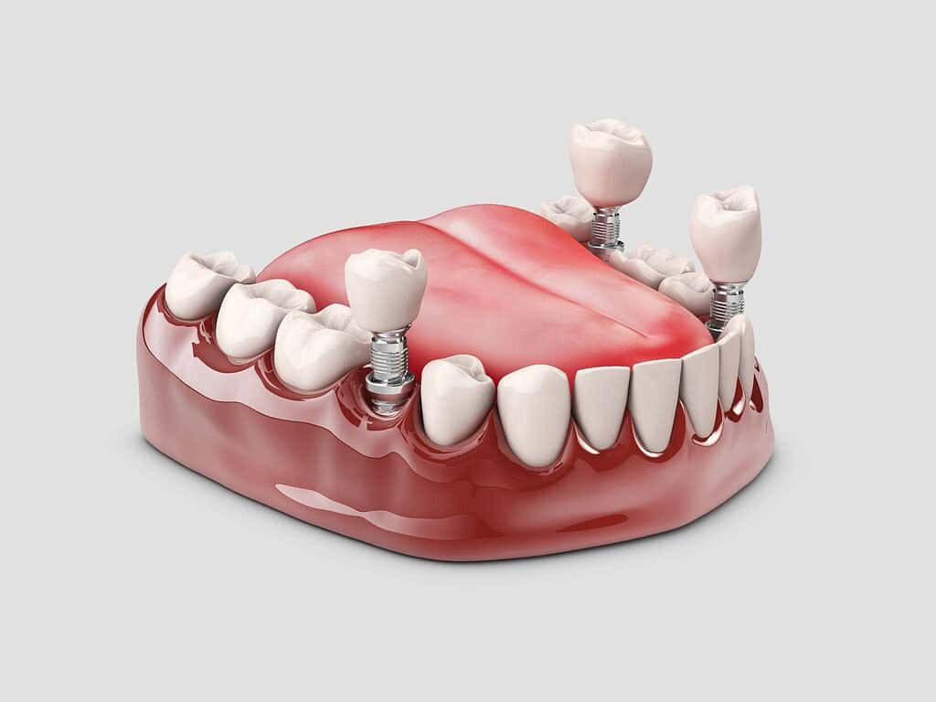 Immagine che illustra impianti dentali convenienti e di alta qualità in Albania.