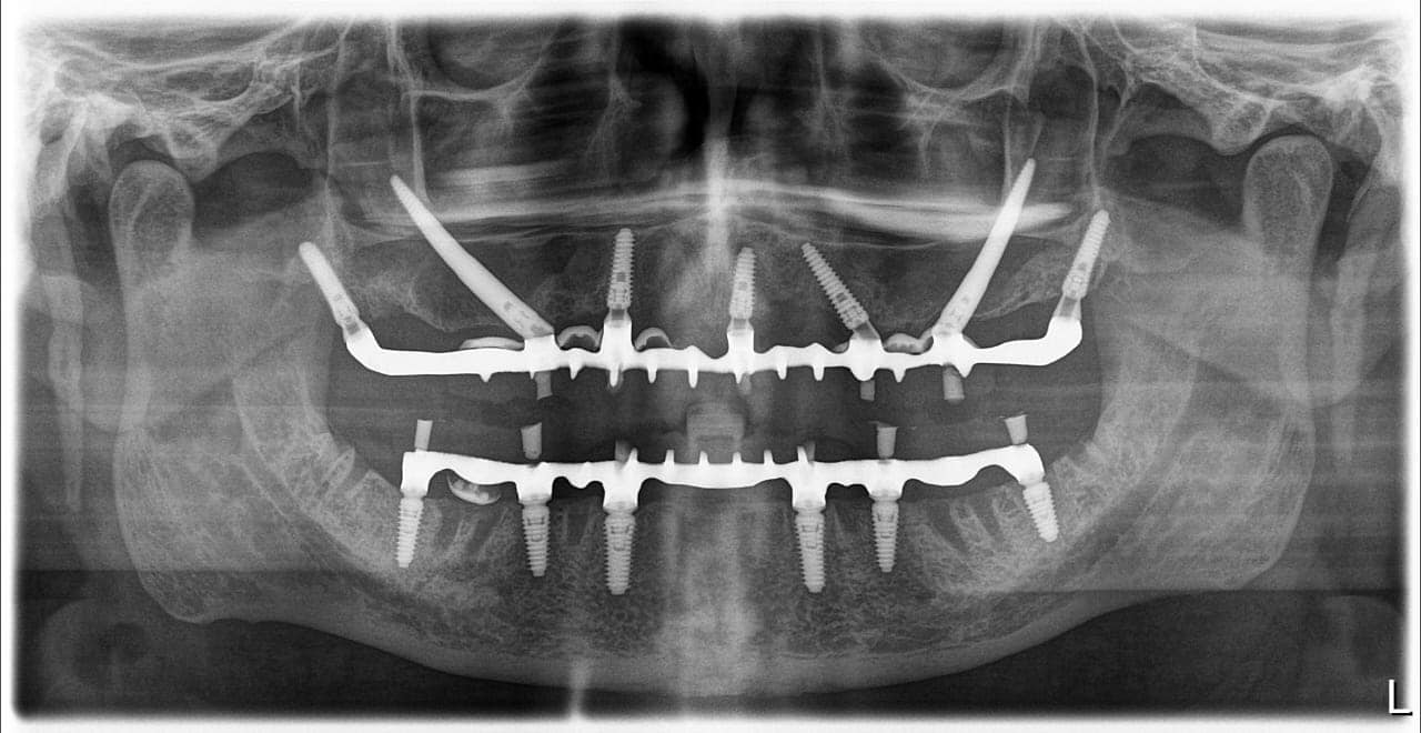 X ray impianti pterigoidei