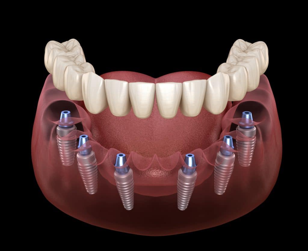 impianti dentali all on 6 in Albania