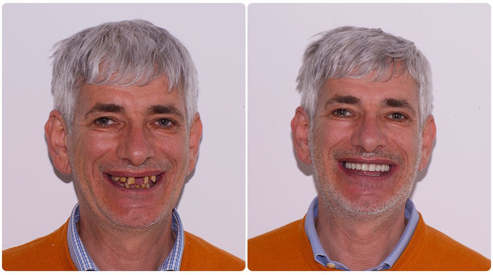 Rezultati i transformimit total me implante te gojes