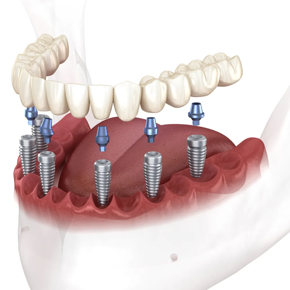 Implante dentare all on 6