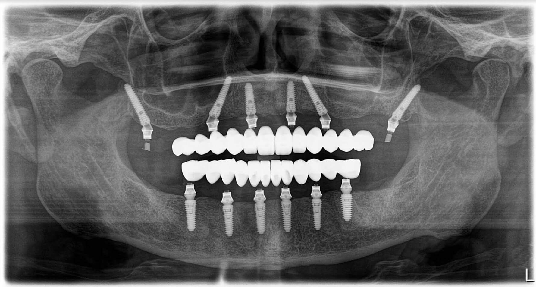 Radiografi e implanteve dentare. 